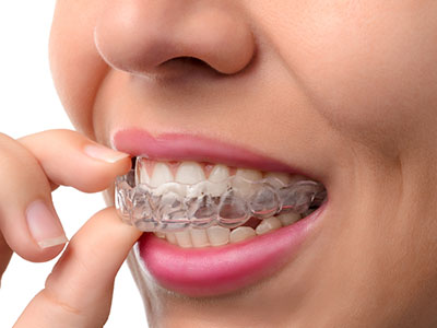 The image shows a person with an Invisalign teeth alignment device, examining their teeth while holding a small piece of the aligner between their fingers.