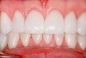 The image shows a close-up view of a person s teeth with a focus on the front teeth, which appear to be part of a dental procedure or treatment.