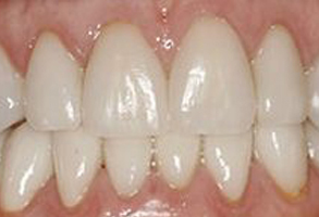 The image shows a close-up of a person s teeth with a focus on an area where dental work appears to be in progress, likely involving a tooth filling or preparation for a crown.