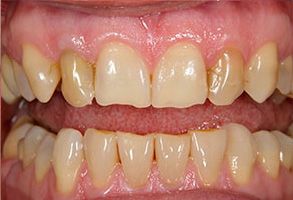 The image shows a close-up of a person s mouth with yellowish teeth and visible signs of wear and discoloration, likely due to aging or poor oral hygiene.